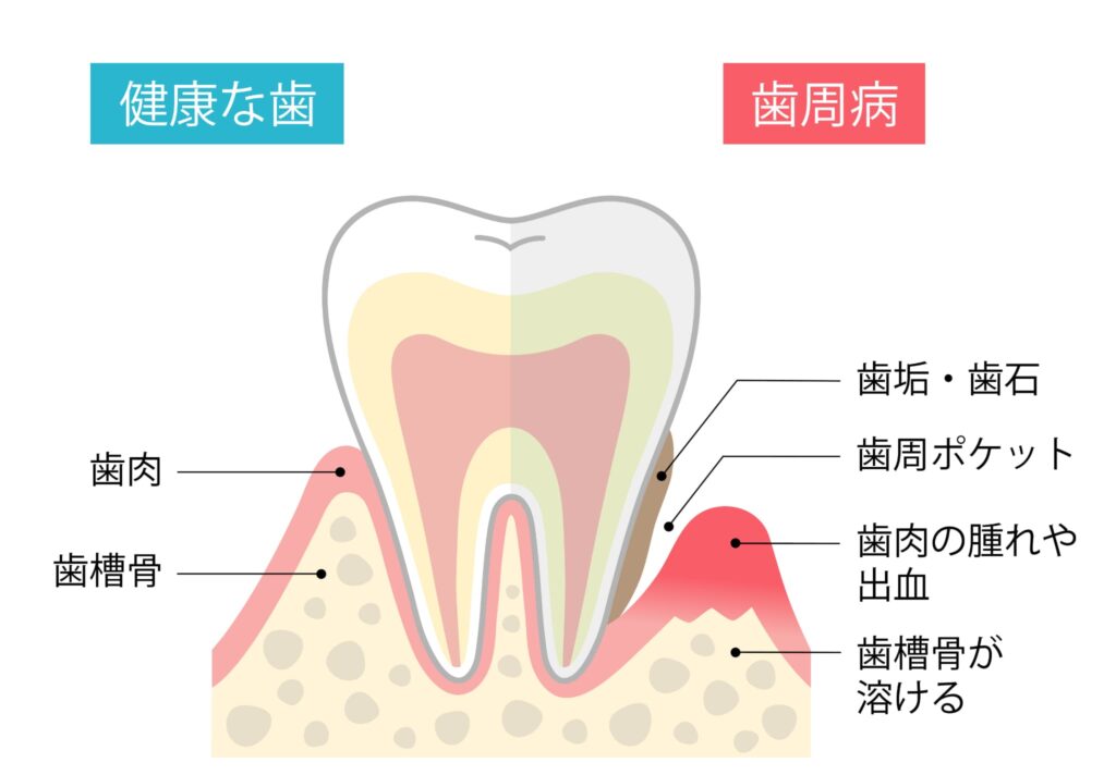 健康な歯と歯周病の歯の比較